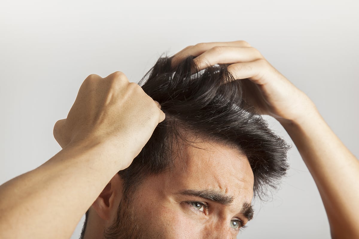 man with seborrhoeic dermatitis in scalp