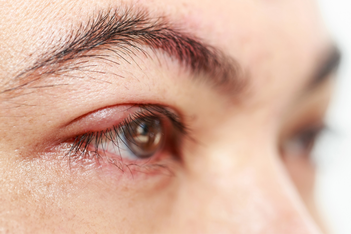 You Woke Up With Swollen Eyes or Eyelids? Don't Panic!