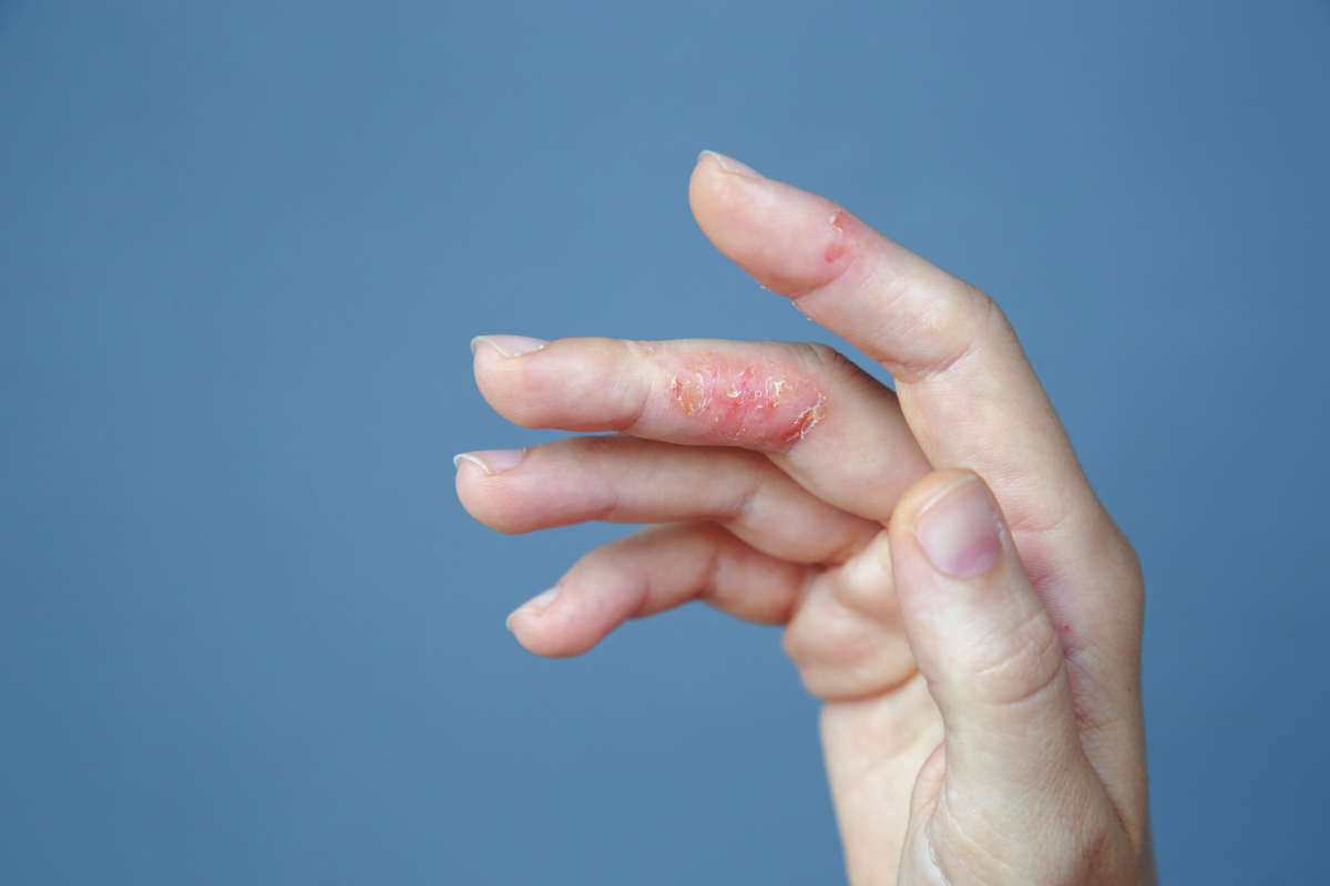 Hand eczema around the fingers.