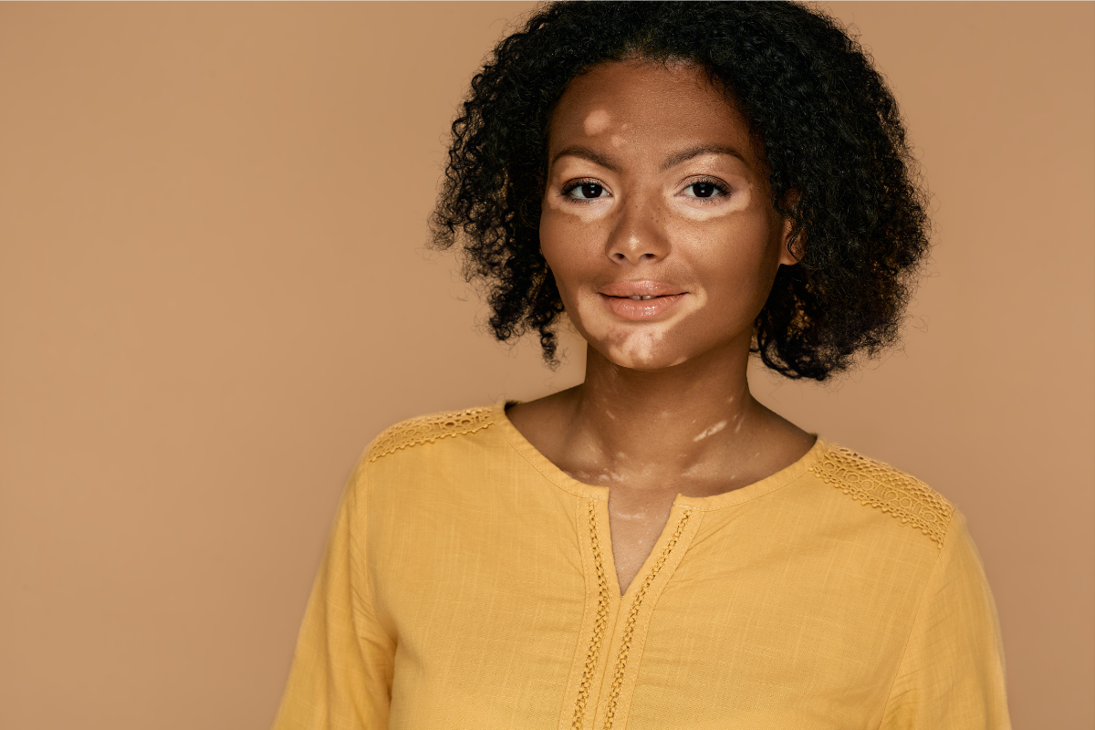 black woman with vitiligo marks on her face