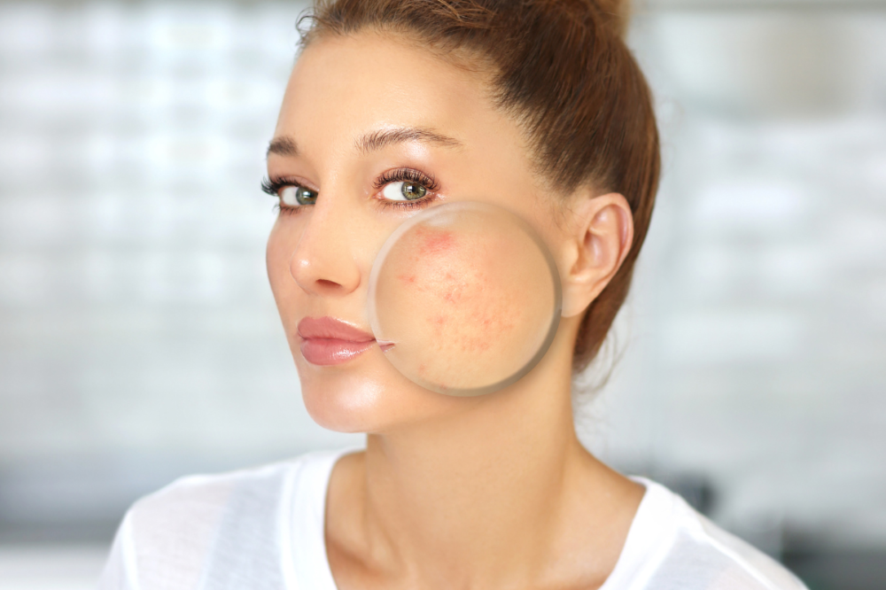 Magnifying glass shos hormonal acne on woman's face