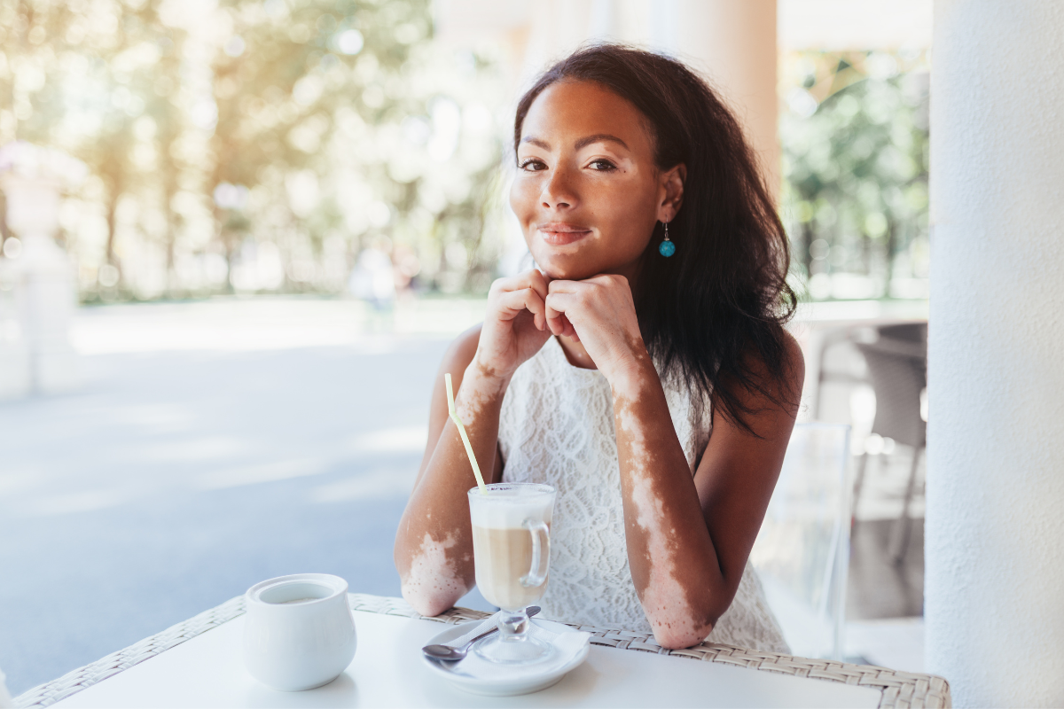 woman with vitiligo takew a coffee