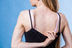 woman showing pimples on her back